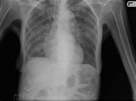 1000mg of test a week results|Tuberculosis isn't often seen in Australia, but I tested positive for .